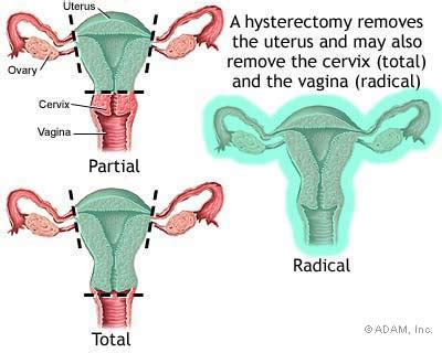 endometriosis pain after full hysterectomy